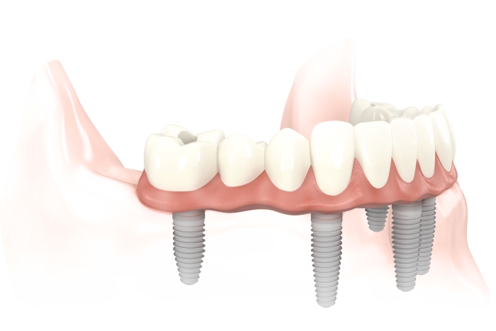 Implantes dentales